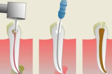 Ce este un tratament endodontic?